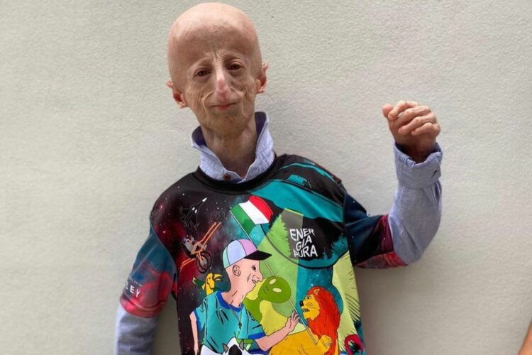 Sammy Basso malattia: cos’è la progeria